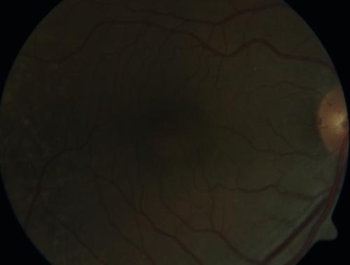 Ocular Lymphoma - non-Hodgkins - B-Cell
Multifocal sub-RPE lesions in the left eye of a patient with history of Non-hodgkins B-cell Lymphoma last active 2 years ago
