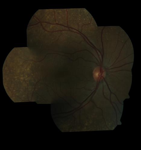 Ocular Lymphoma - non-Hodgkins - B-Cell
Multifocal sub-RPE lesions in the left eye of a patient with history of Non-hodgkins B-cell Lymphoma last active 2 years ago
