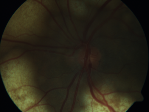 Ocular Lymphoma - non-Hodgkins - B-Cell
Multifocal sub-RPE lesions in the left eye of a patient with history of Non-hodgkins B-cell Lymphoma last active 2 years ago
