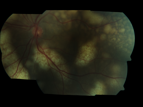Ocular Lymphoma - non-Hodgkins - B-Cell
Multifocal sub-RPE lesions in the left eye of a patient with history of Non-hodgkins B-cell Lymphoma last active 2 years ago
