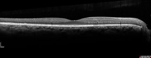 Ocular Lymphoma - non-Hodgkins - B-Cell - Right eye has equatorial drusen
Multifocal sub-RPE lesions in the left eye of a patient with history of Non-hodgkins B-cell Lymphoma last active 2 years ago
