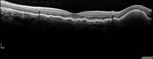 Ocular Lymphoma - non-Hodgkins - B-Cell - OCT shows multifocal sub-RPE masses 
Multifocal sub-RPE lesions in the left eye of a patient with history of Non-hodgkins B-cell Lymphoma last active 2 years ago
