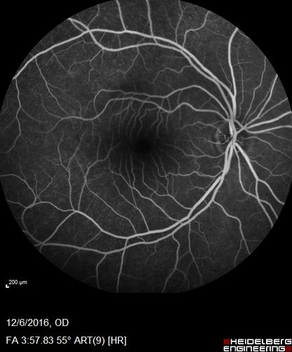 Ocular Lymphoma - non-Hodgkins - B-Cell - Right eye has equatorial drusen
Multifocal sub-RPE lesions in the left eye of a patient with history of Non-hodgkins B-cell Lymphoma last active 2 years ago
