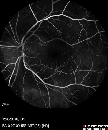 Ocular Lymphoma - non-Hodgkins - B-Cell
Multifocal sub-RPE lesions in the left eye of a patient with history of Non-hodgkins B-cell Lymphoma last active 2 years ago
