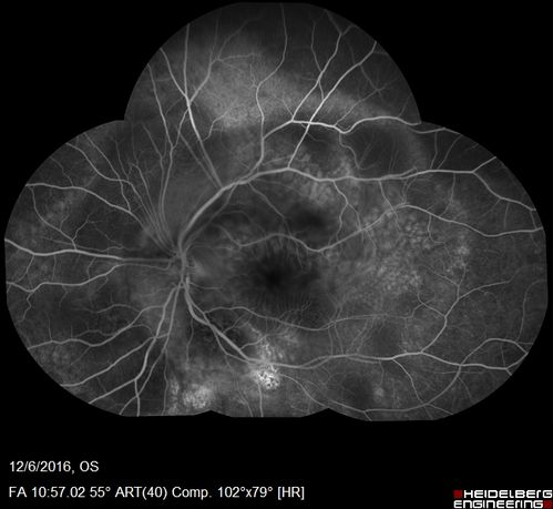 Ocular Lymphoma - non-Hodgkins - B-Cell
Multifocal sub-RPE lesions in the left eye of a patient with history of Non-hodgkins B-cell Lymphoma last active 2 years ago
