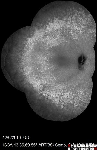 Ocular Lymphoma - non-Hodgkins - B-Cell
Multifocal sub-RPE lesions in the left eye of a patient with history of Non-hodgkins B-cell Lymphoma last active 2 years ago
