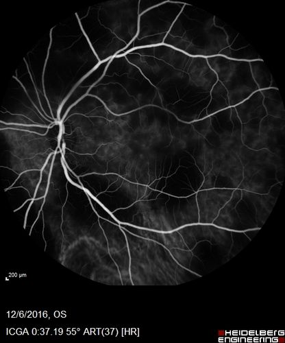 Ocular Lymphoma - non-Hodgkins - B-Cell
Multifocal sub-RPE lesions in the left eye of a patient with history of Non-hodgkins B-cell Lymphoma last active 2 years ago
