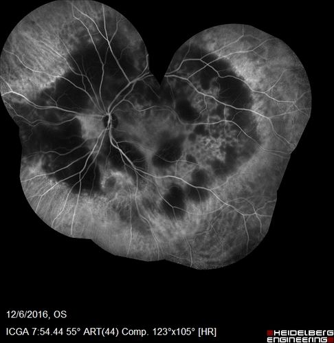 Ocular Lymphoma - non-Hodgkins - B-Cell
Multifocal sub-RPE lesions in the left eye of a patient with history of Non-hodgkins B-cell Lymphoma last active 2 years ago
