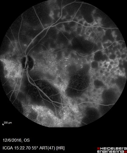 Ocular Lymphoma - non-Hodgkins - B-Cell
Multifocal sub-RPE lesions in the left eye of a patient with history of Non-hodgkins B-cell Lymphoma last active 2 years ago

