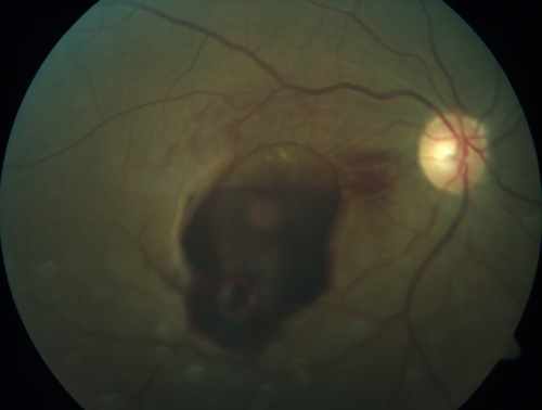 Macroaneurysm - Macular Hemorrhage - Branch Retinal Aterial Occlusion
62 year old African American female with chronic hypertension and vision loss for 2 weeks.  VA is 20/400
