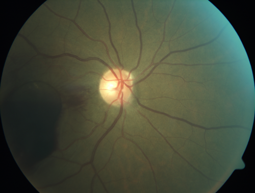 Macroaneurysm - Macular Hemorrhage - Branch Retinal Aterial Occlusion
62 year old African American female with chronic hypertension and vision loss for 2 weeks.  VA is 20/400
