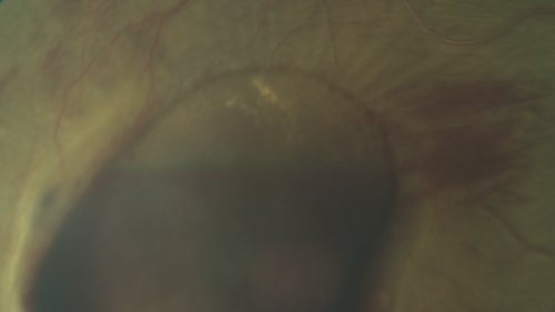 Macroaneurysm - Macular Hemorrhage - Branch Retinal Aterial Occlusion
62 year old African American female with chronic hypertension and vision loss for 2 weeks.  VA is 20/400
