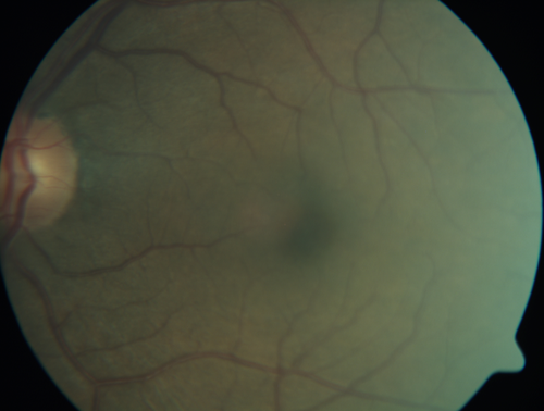Macroaneurysm - Macular Hemorrhage - Branch Retinal Aterial Occlusion
62 year old African American female with chronic hypertension and vision loss for 2 weeks.  VA is 20/400
