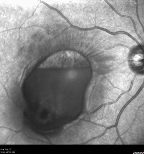 Macroaneurysm - Macular Hemorrhage - Branch Retinal Aterial Occlusion
62 year old African American female with chronic hypertension and vision loss for 2 weeks.  VA is 20/400
