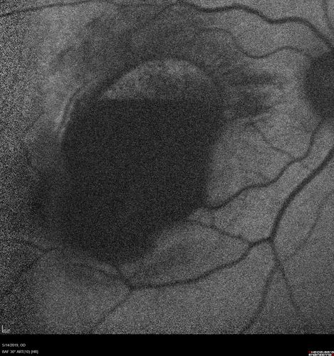 Macroaneurysm - Macular Hemorrhage - Branch Retinal Aterial Occlusion
62 year old African American female with chronic hypertension and vision loss for 2 weeks.  VA is 20/400
