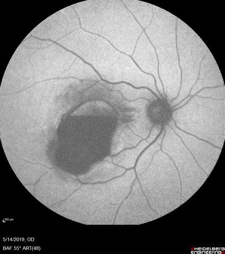 Macroaneurysm - Macular Hemorrhage - Branch Retinal Aterial Occlusion
62 year old African American female with chronic hypertension and vision loss for 2 weeks.  VA is 20/400
