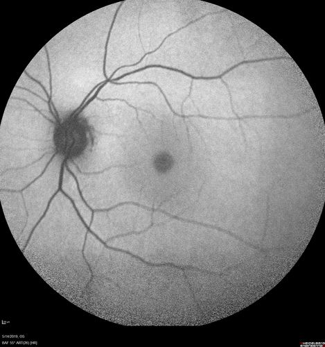 Macroaneurysm - Macular Hemorrhage - Branch Retinal Aterial Occlusion
62 year old African American female with chronic hypertension and vision loss for 2 weeks.  VA is 20/400
