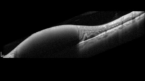 Macroaneurysm - Macular Hemorrhage - Branch Retinal Aterial Occlusion
62 year old African American female with chronic hypertension and vision loss for 2 weeks.  VA is 20/400
