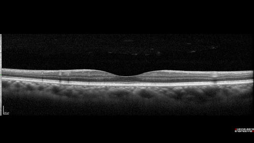 Macroaneurysm - Macular Hemorrhage - Branch Retinal Aterial Occlusion
62 year old African American female with chronic hypertension and vision loss for 2 weeks.  VA is 20/400
