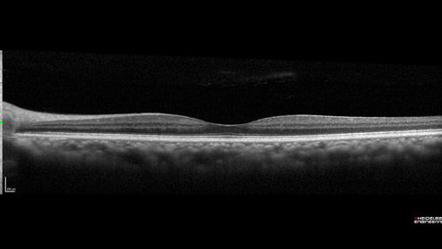 Macroaneurysm - Macular Hemorrhage - Branch Retinal Aterial Occlusion
62 year old African American female with chronic hypertension and vision loss for 2 weeks.  VA is 20/400
