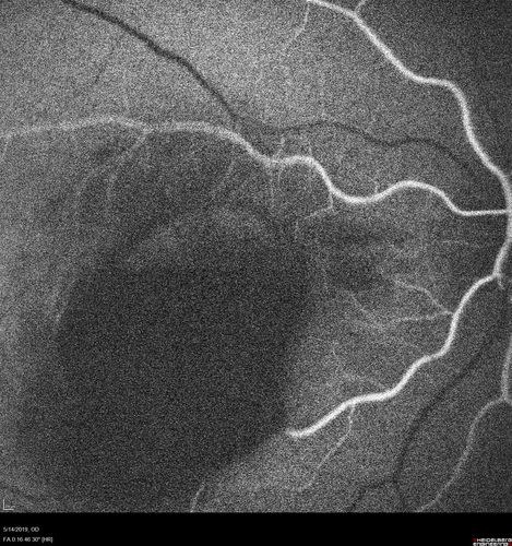Macroaneurysm - Macular Hemorrhage - Branch Retinal Aterial Occlusion
62 year old African American female with chronic hypertension and vision loss for 2 weeks.  VA is 20/400
