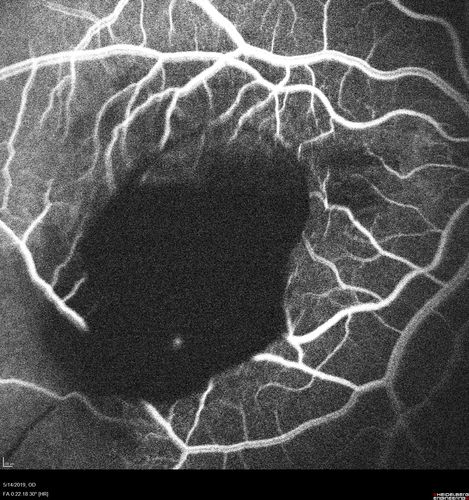 Macroaneurysm - Macular Hemorrhage - Branch Retinal Aterial Occlusion
62 year old African American female with chronic hypertension and vision loss for 2 weeks.  VA is 20/400
