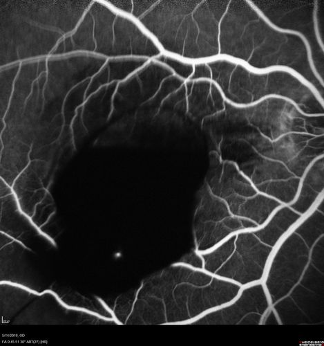 Macroaneurysm - Macular Hemorrhage - Branch Retinal Aterial Occlusion
62 year old African American female with chronic hypertension and vision loss for 2 weeks.  VA is 20/400
