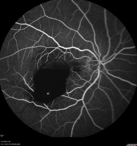 Macroaneurysm - Macular Hemorrhage - Branch Retinal Aterial Occlusion
62 year old African American female with chronic hypertension and vision loss for 2 weeks.  VA is 20/400
