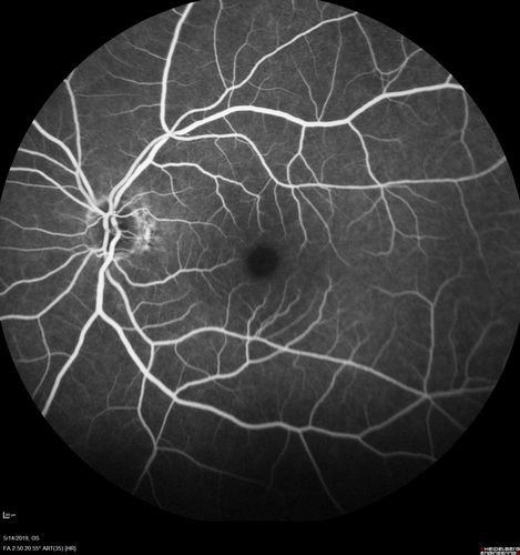 Macroaneurysm - Macular Hemorrhage - Branch Retinal Aterial Occlusion
62 year old African American female with chronic hypertension and vision loss for 2 weeks.  VA is 20/400
