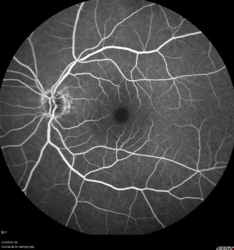 Macroaneurysm - Macular Hemorrhage - Branch Retinal Aterial Occlusion
62 year old African American female with chronic hypertension and vision loss for 2 weeks.  VA is 20/400
