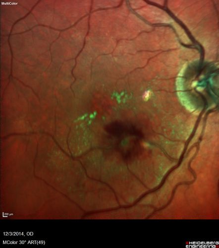 Macroaneurysm - Resolved without treatment
87 year old female with vision loss OD.  Initial FA showed no leakage so no treatment was done and the fluid absorbed over 4 months.  Initial VA 20/100, Final VA 20/80
