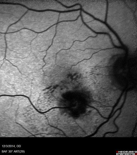 Macroaneurysm - Resolved without treatment
87 year old female with vision loss OD.  Initial FA showed no leakage so no treatment was done and the fluid absorbed over 4 months.  Initial VA 20/100, Final VA 20/80
