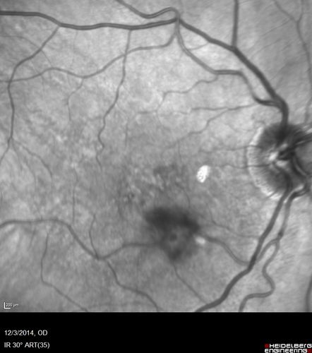 Macroaneurysm - Resolved without treatment
87 year old female with vision loss OD.  Initial FA showed no leakage so no treatment was done and the fluid absorbed over 4 months.  Initial VA 20/100, Final VA 20/80
