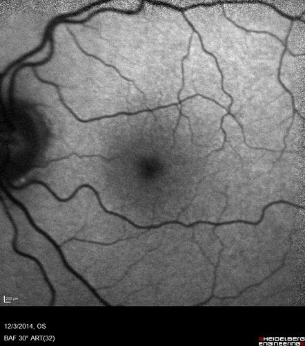 Macroaneurysm - Resolved without treatment
87 year old female with vision loss OD.  Initial FA showed no leakage so no treatment was done and the fluid absorbed over 4 months.  Initial VA 20/100, Final VA 20/80
