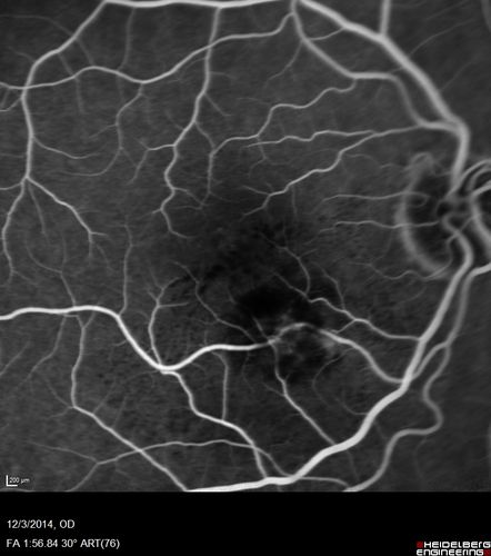 Macroaneurysm - Resolved without treatment
87 year old female with vision loss OD.  Initial FA showed no leakage so no treatment was done and the fluid absorbed over 4 months.  Initial VA 20/100, Final VA 20/80
