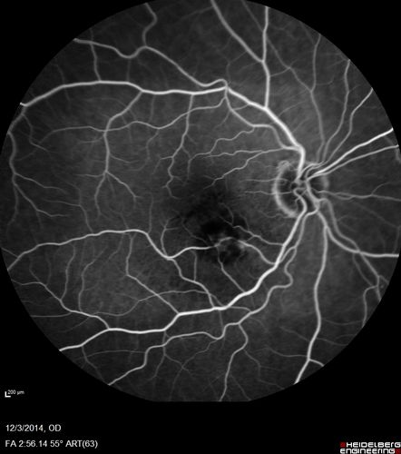 Macroaneurysm - Resolved without treatment
87 year old female with vision loss OD.  Initial FA showed no leakage so no treatment was done and the fluid absorbed over 4 months.  Initial VA 20/100, Final VA 20/80

