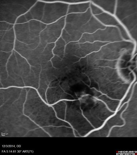 Macroaneurysm - Resolved without treatment
87 year old female with vision loss OD.  Initial FA showed no leakage so no treatment was done and the fluid absorbed over 4 months.  Initial VA 20/100, Final VA 20/80

