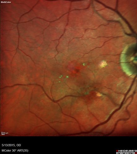 Macroaneurysm - Resolved without treatment
87 year old female with vision loss OD.  Initial FA showed no leakage so no treatment was done and the fluid absorbed over 4 months.  Initial VA 20/100, Final VA 20/80

