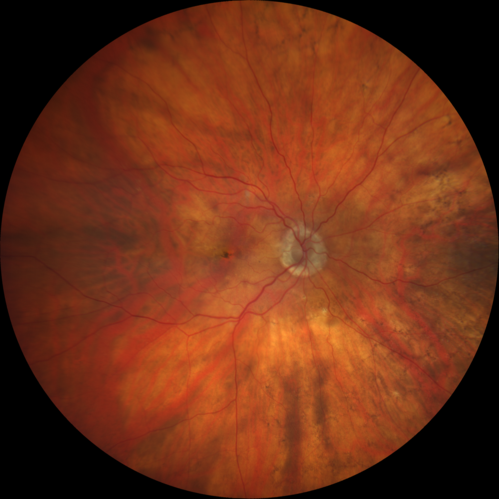 Retinal Arterial Macroaneurysm - Boat Shaped Hemorrhage
93 year old woman getting every 2 months Lucentis injection for wet AMD developed a ruptured MA.  No treatment was done and the vision improved
