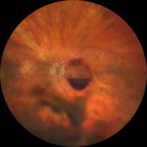 Retinal Arterial Macroaneurysm - Boat Shaped Hemorrhage
93 year old woman getting every 2 months Lucentis injection for wet AMD developed a ruptured MA.  No treatment was done and the vision improved
