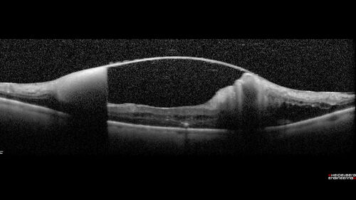 Retinal Arterial Macroaneurysm - Boat Shaped Hemorrhage
93 year old woman getting every 2 months Lucentis injection for wet AMD developed a ruptured MA.  No treatment was done and the vision improved
