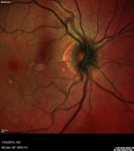 Retinal Arterial  Macroaneurysm treated with Laser
89 year old female with peripapillary CNVM treated with Lucentis. Vision was 20/25 OS 3 weeks ago.  She noticed vision loss OS.  Vision had dropped to 20/60.  She had a fresh MA and was treated with laser.
