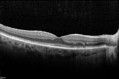 Retinal Arterial  Macroaneurysm treated with Laser
89 year old female with peripapillary CNVM treated with Lucentis. Vision was 20/25 OS 3 weeks ago.  She noticed vision loss OS.  Vision had dropped to 20/60.  She had a fresh MA and was treated with laser.
