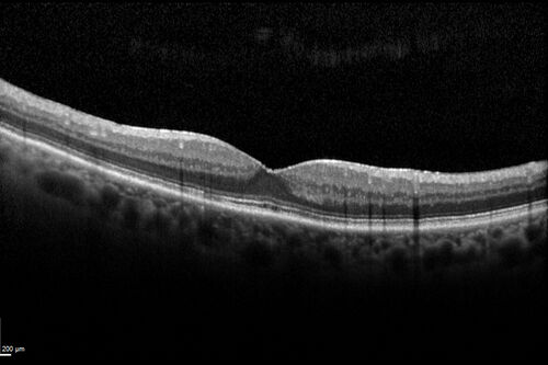 Retinal Arterial  Macroaneurysm treated with Laser
89 year old female with peripapillary CNVM treated with Lucentis. Vision was 20/25 OS 3 weeks ago.  She noticed vision loss OS.  Vision had dropped to 20/60.  She had a fresh MA and was treated with laser.
