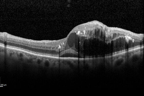 Retinal Arterial  Macroaneurysm treated with Laser
89 year old female with peripapillary CNVM treated with Lucentis. Vision was 20/25 OS 3 weeks ago.  She noticed vision loss OS.  Vision had dropped to 20/60.  She had a fresh MA and was treated with laser.
