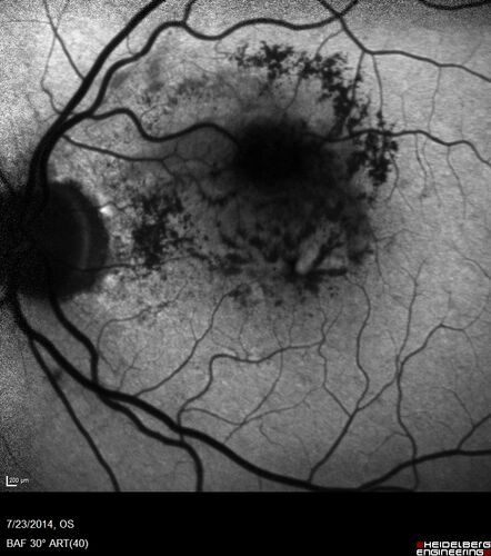 Retinal Arterial  Macroaneurysm treated with Laser
89 year old female with peripapillary CNVM treated with Lucentis. Vision was 20/25 OS 3 weeks ago.  She noticed vision loss OS.  Vision had dropped to 20/60.  She had a fresh MA and was treated with laser.

