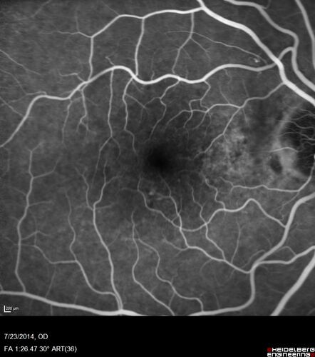 Retinal Arterial  Macroaneurysm treated with Laser
89 year old female with peripapillary CNVM treated with Lucentis. Vision was 20/25 OS 3 weeks ago.  She noticed vision loss OS.  Vision had dropped to 20/60.  She had a fresh MA and was treated with laser.
