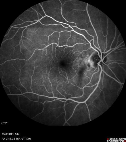 Retinal Arterial  Macroaneurysm treated with Laser
89 year old female with peripapillary CNVM treated with Lucentis. Vision was 20/25 OS 3 weeks ago.  She noticed vision loss OS.  Vision had dropped to 20/60.  She had a fresh MA and was treated with laser.
