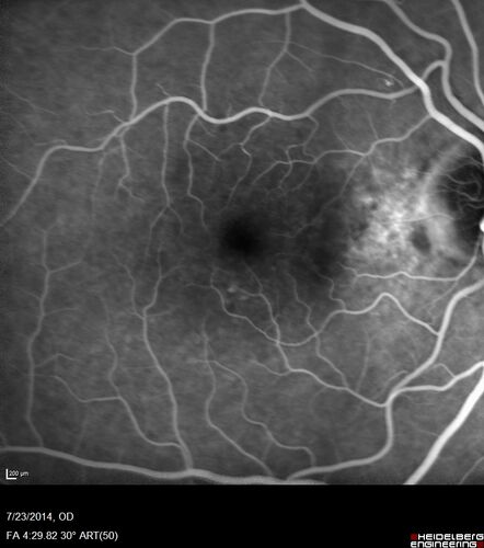 Retinal Arterial  Macroaneurysm treated with Laser
89 year old female with peripapillary CNVM treated with Lucentis. Vision was 20/25 OS 3 weeks ago.  She noticed vision loss OS.  Vision had dropped to 20/60.  She had a fresh MA and was treated with laser.
