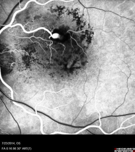 Retinal Arterial  Macroaneurysm treated with Laser
89 year old female with peripapillary CNVM treated with Lucentis. Vision was 20/25 OS 3 weeks ago.  She noticed vision loss OS.  Vision had dropped to 20/60.  She had a fresh MA and was treated with laser.
